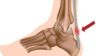 Viêm gân Achilles là gì? Loại chấn thương này có nguy hiểm không