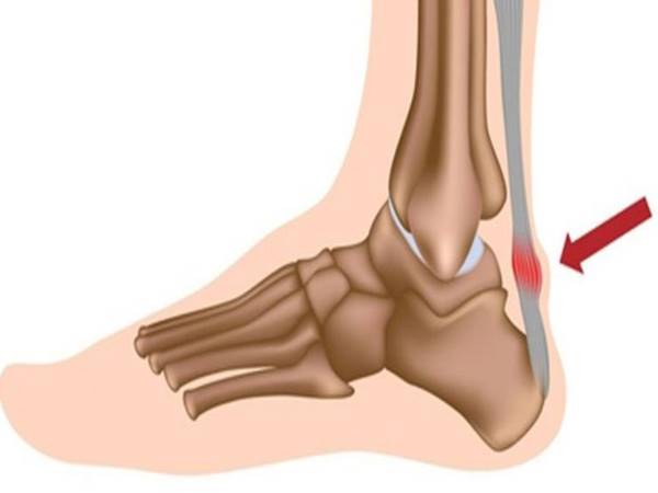 Viêm gân Achilles là gì? Loại chấn thương này có nguy hiểm không